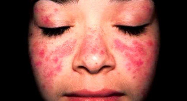 Красная волчанка