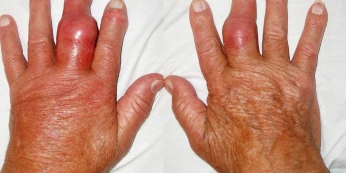 подагра у женщин