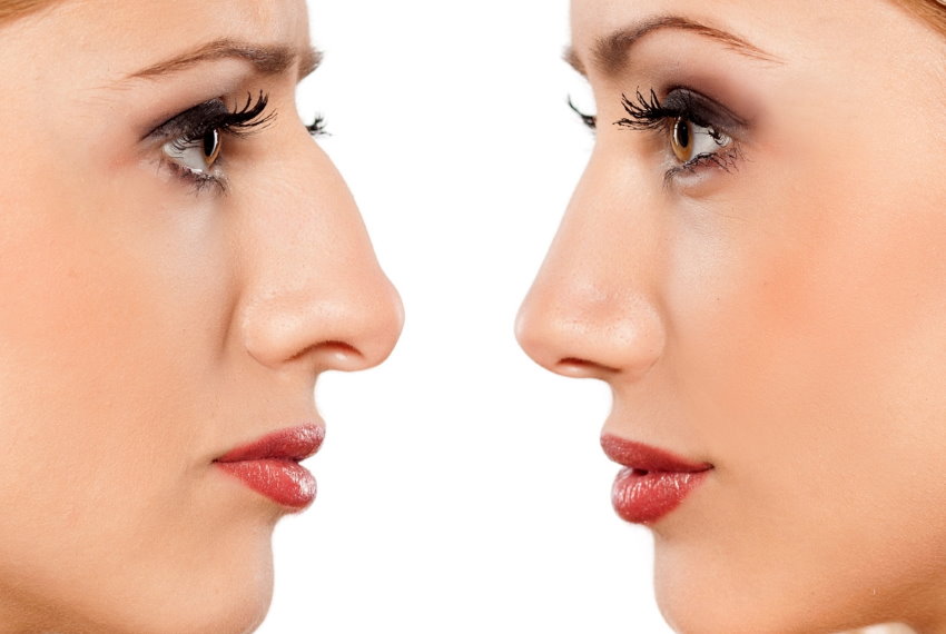 Ринопластика носа у доктора Бабаяна Гайка Павловича