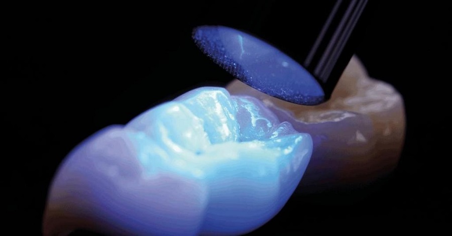 Почему стоит поставить на зуб световую пломбу