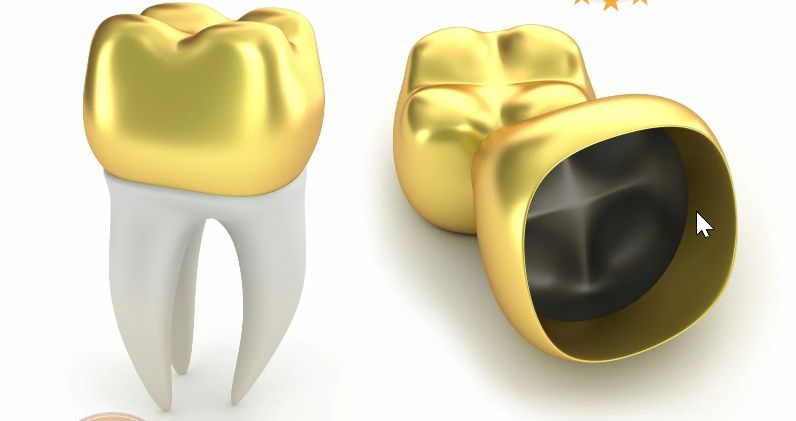 Скупка стоматологического золота: выгодное вложение или ненужные хлопоты?