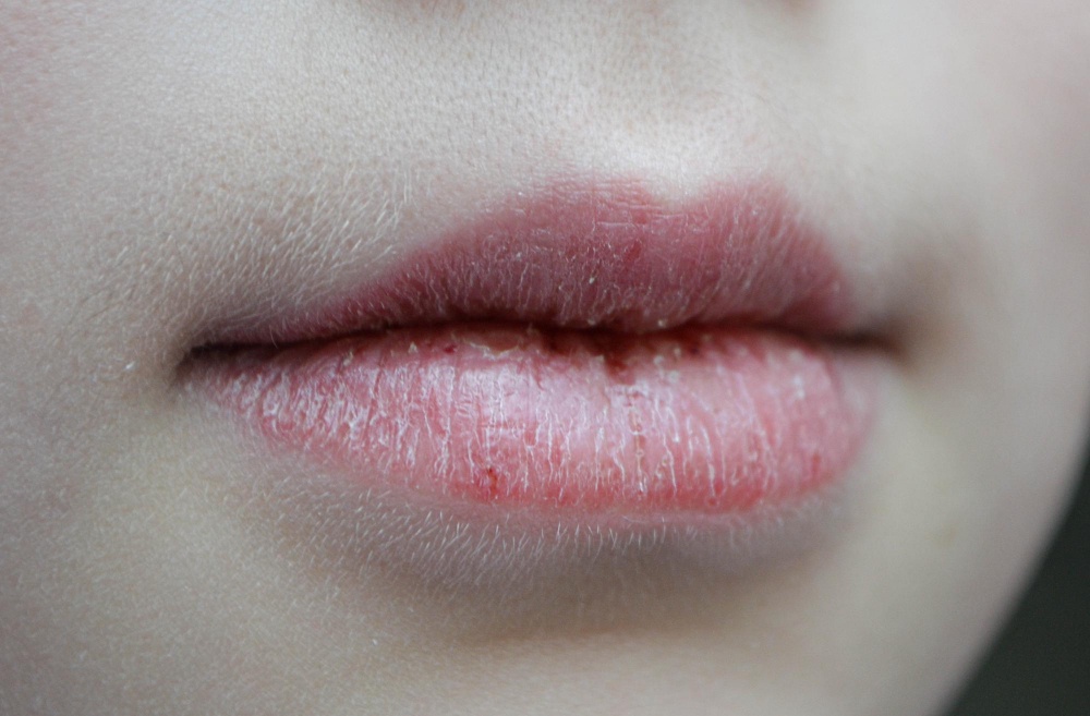 Сухие губы: причины и способы борьбы круглый год