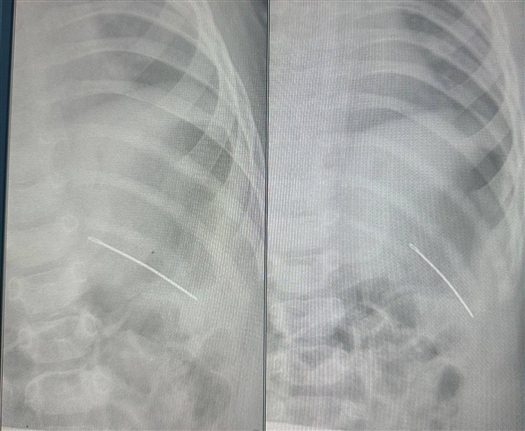 Хирурги из Самары удалили швейную иглу из груди младенца