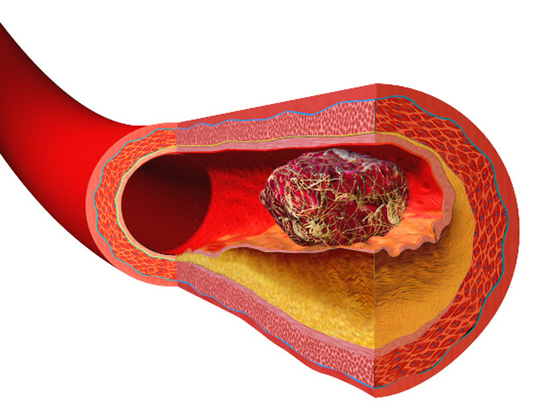 Профессор МГУ назвал основные причины отрыва тромба