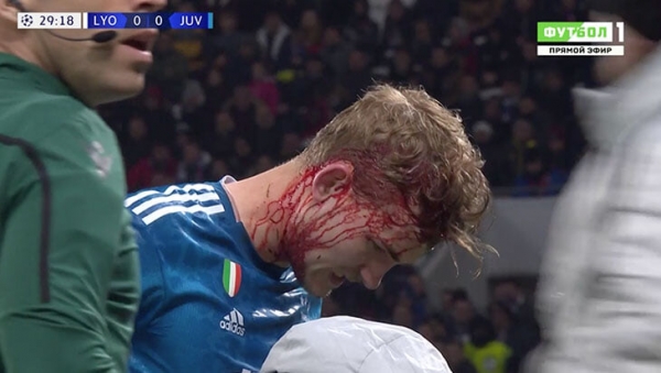 Эпично окровавленный де Лигт: ему разбили голову и расцарапали грудь
