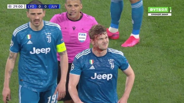 Эпично окровавленный де Лигт: ему разбили голову и расцарапали грудь