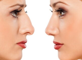 Ринопластика носа у доктора Бабаяна Гайка Павловича