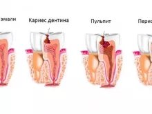 Как проходит лечение кариеса?