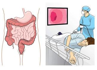 Колоноскопия: основные аспекты, подготовка и процедура