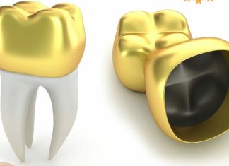 Скупка стоматологического золота: выгодное вложение или ненужные хлопоты?