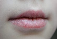 Сухие губы: причины и способы борьбы круглый год