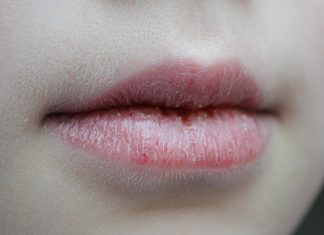 Сухие губы: причины и способы борьбы круглый год