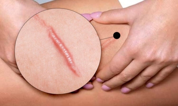 Пластырь из глистов: ученые нашли способ заживлять раны без шрамов - Hi-News.ru