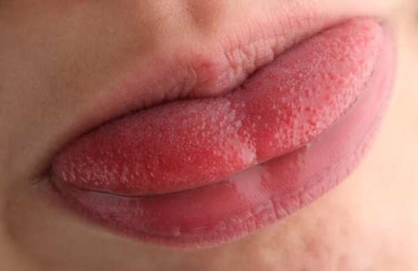 Цвет языка может многое рассказать о вашем здоровье: проверьте себя прямо сейчас - Hi-News.ru