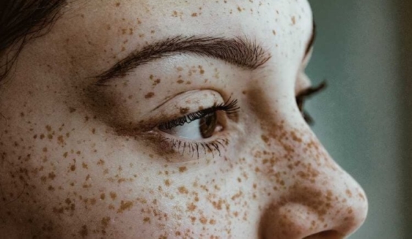 Почему у некоторых людей появляются веснушки, а у других нет - Hi-News.ru