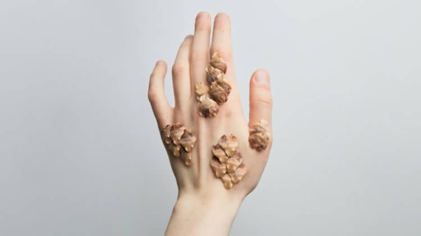 Укол от псориаза стоит 52 000$ в США. Цена препарата в России вас сильно удивит - Hi-News.ru